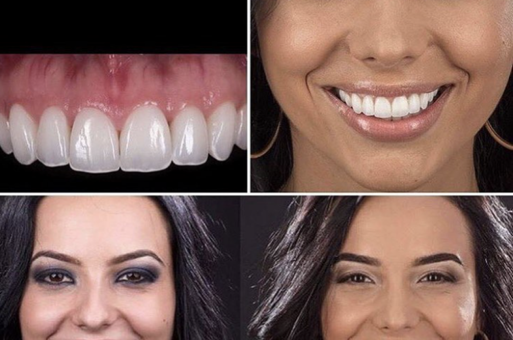 Introduction to Veneers and Dental Crowns in Phoenix AZ: Enhancing Your Smile with Cosmetic Dentistry