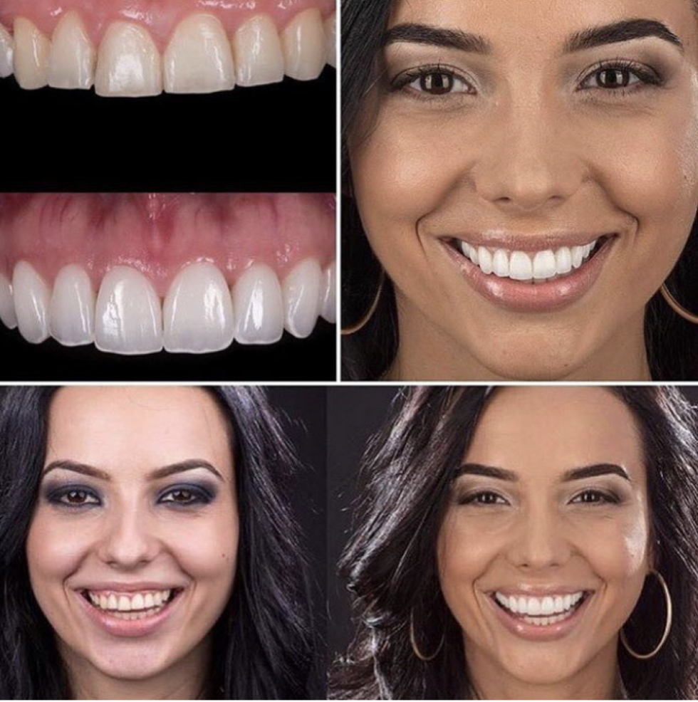Introduction to Veneers and Dental Crowns in Phoenix AZ Enhancing Your